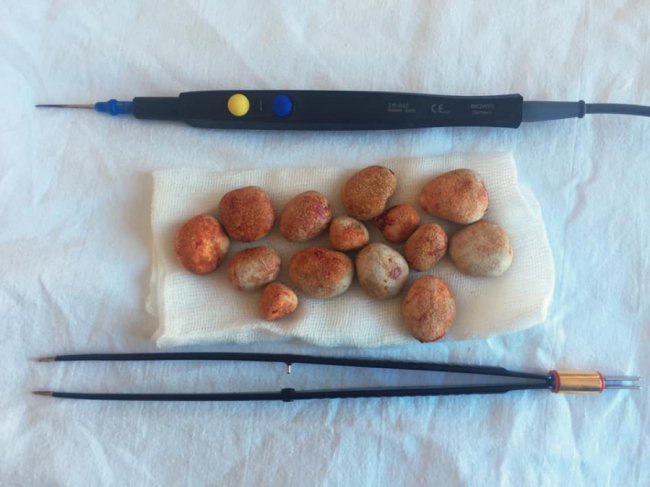 Волинські медики видалили 14 каменів з нирок пацієнта. ФОТО