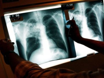 Туберкульоз на Волині: яка ситуація із захворюваністю та лікуванням