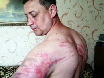Колишній полонений «ДНР» показав, як знущалися терористи. ФОТО
