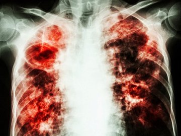 «На туберкульоз може захворіти кожен», – лікар з Луцька про прогресування епідемії через Covid-19