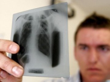 На Волині за рік 700 осіб захворіли на туберкульоз