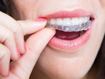 Капа – ідеальне рішення для вирівнювання зубів*