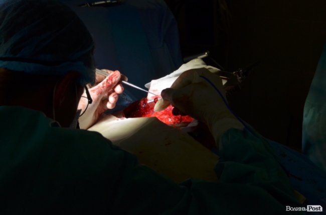 Зупинити серце, аби «перешити» і продовжити життя: репортаж з операційної обласної лікарні. ФОТО 18+