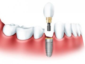 Імплантація зубів, як найефективніший метод відновлення*