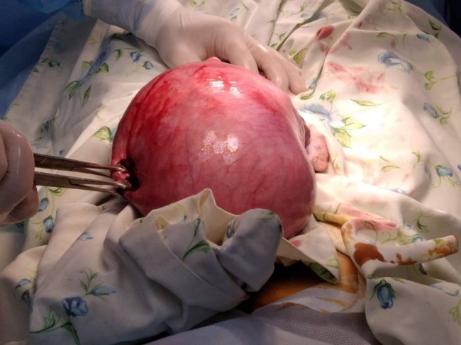 У волинській лікарні жінці видалили пухлину, розміром з футбольний м'яч. ФОТО 18+