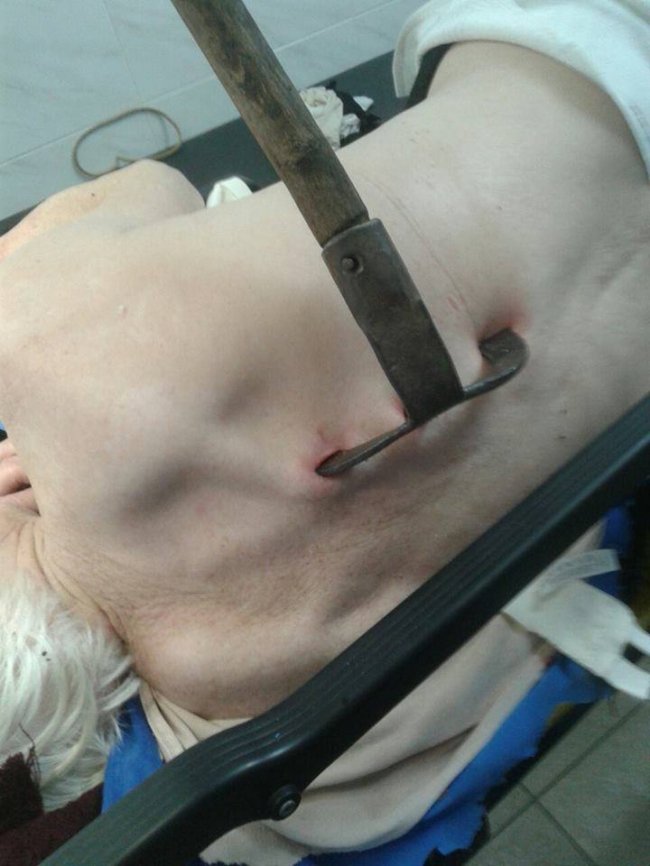 До ковельської лікарні потрапила жінка з копачкою у спині. ФОТО 18+
