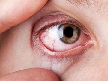 Волинські лікарі витягли з ока пацієнта гельмінта довжиною більше 12 сантиметрів