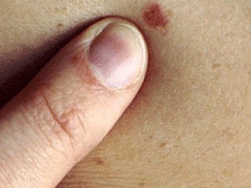Рак шкіри: як діагностувати хворобу та зберегти життя*
