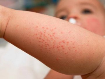 На Волині вистачає вакцини від кору для дітей