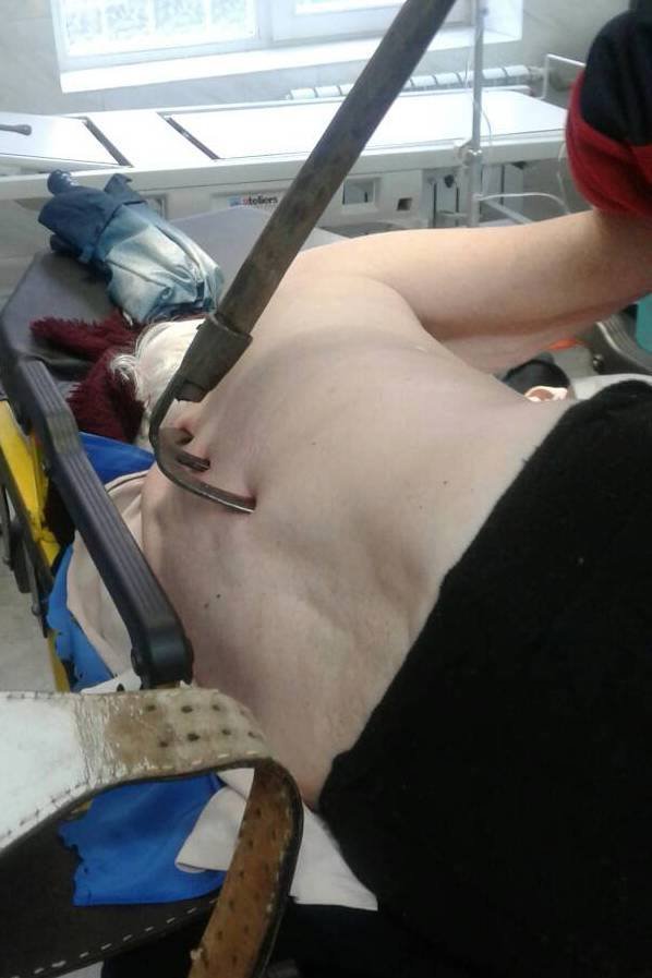 До ковельської лікарні потрапила жінка з копачкою у спині. ФОТО 18+