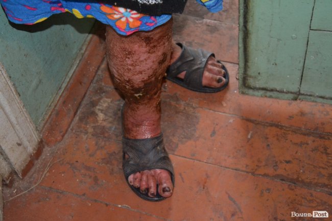 ноги Марії вкриті виразками