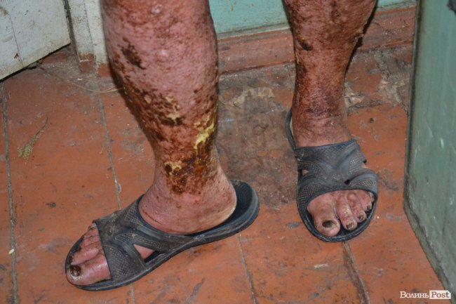 ноги Марії вкриті виразками