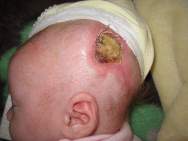 Фото зроблене за кілька тижнів після отримання дитиною опіків 