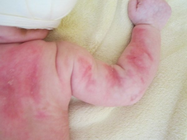 Дитячі рани і мамині муки: що заважає вилікувати скалічене в лікарні немовля?