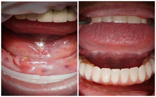 Куди зникають видалені зуби і чим грозять зуби мудрості: відповіді луцького хірурга-стоматолога на поширені запитання 