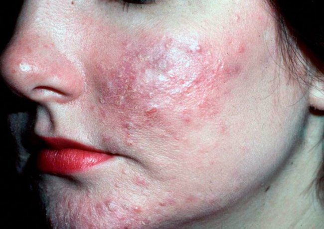 Демодекоз: головний дерматолог Волині спростувала «страшилки» та розповіла про лікування*