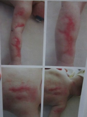 Дитячі рани і мамині муки: що заважає вилікувати скалічене в лікарні немовля?