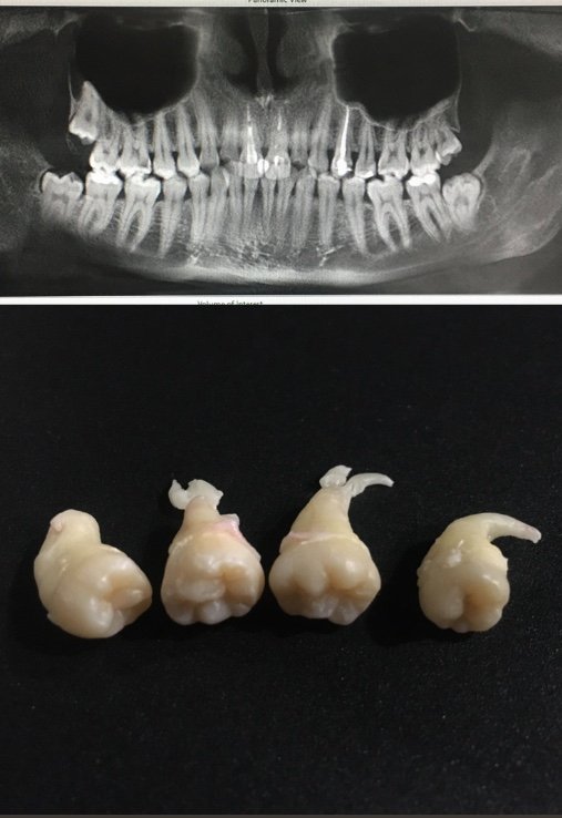 Видалення зубів мудрості: луцький стоматолог розповів, що варто знати кожному пацієнту