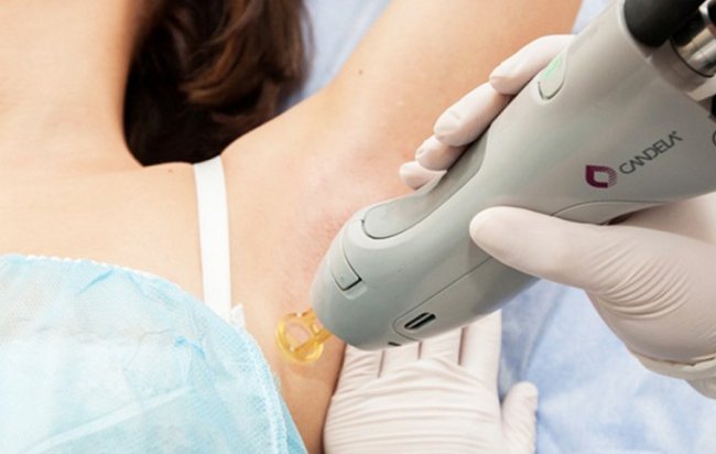 Голитися чи зекономити час і гроші: як позбуватися небажаного волосся