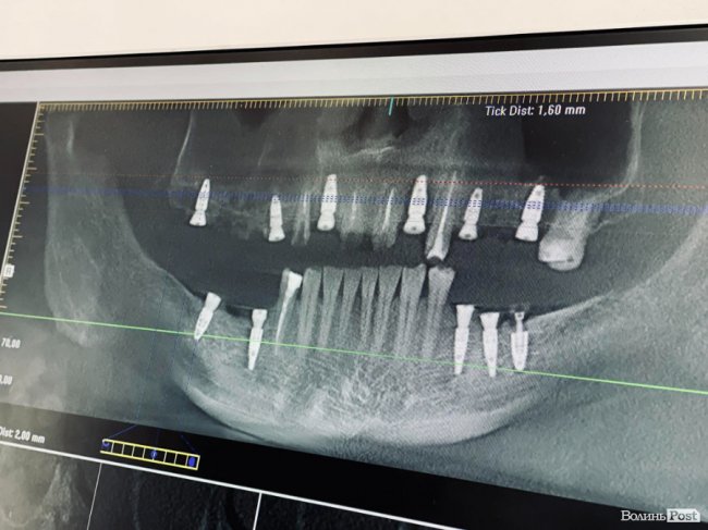 «Це найвдаліший метод відновити втрачений зуб»: лікар з Луцька розповів все про імплантацію 