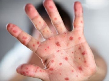 В Україні запровадять обов’язкову вакцинацію від кору 