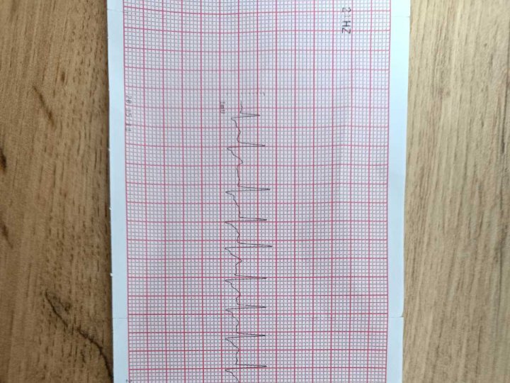 На Волині медики повернули до життя чоловіка, який вдавився