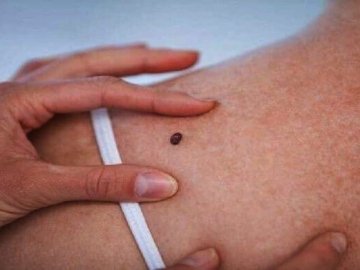 У місті на Волині під час безкоштовного обстеження у 4-х людей виявили рак