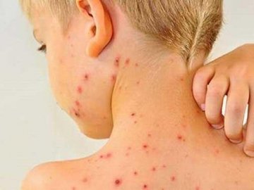 На Волині за тиждень на кір захворіло 81 людей