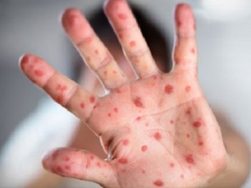65 нових випадків: кір на Волині прогресує