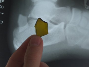 Волинянин пів року ходив зі шматком скла в нозі. ФОТО