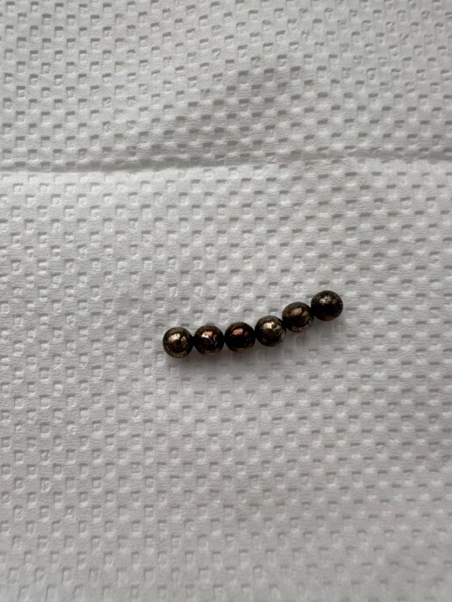 Батарейки, магніти і монети: волинські лікарі розповіли, що доводиться діставати зі стравоходів та дихальних шляхів дітей