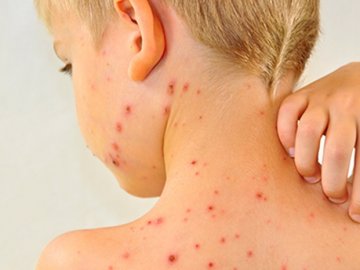 Понад 300 ковельчан захворіли на кір