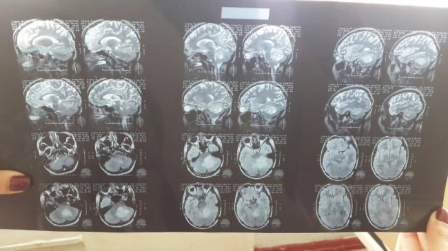 Наодинці у боротьбі з пухлиною: дівчина-сирота з Луцька потребує допомоги