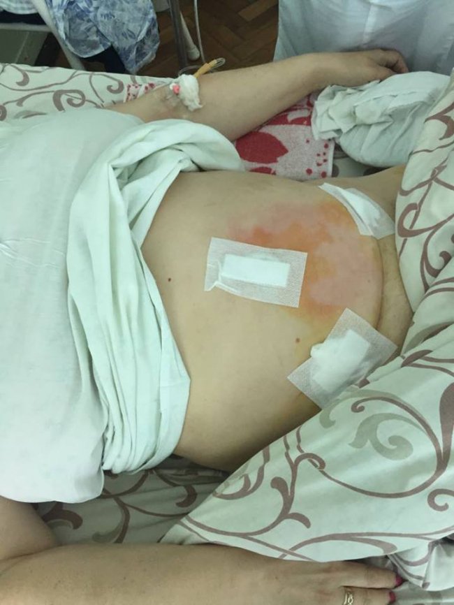 Волинські медики видалили величезну кістому, всередині якої були зуби та волосся. ФОТО 18+