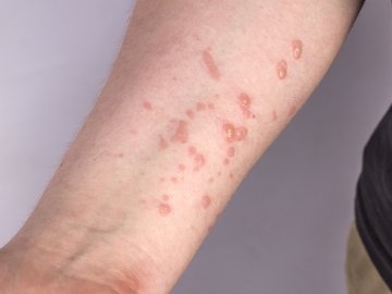 В Україні зареєстрували перший випадок мавпячої віспи