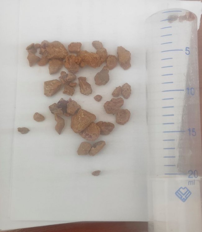 У волинській лікарні пацієнту видалили камінь, що «окупував» всю нирку. ФОТО