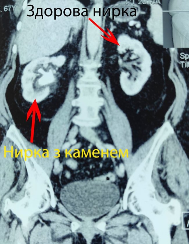 У волинській лікарні пацієнту видалили камінь, що «окупував» всю нирку. ФОТО