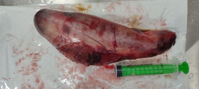 Волинські хірурги видалили гігантський жовчний міхур. ФОТО 18+