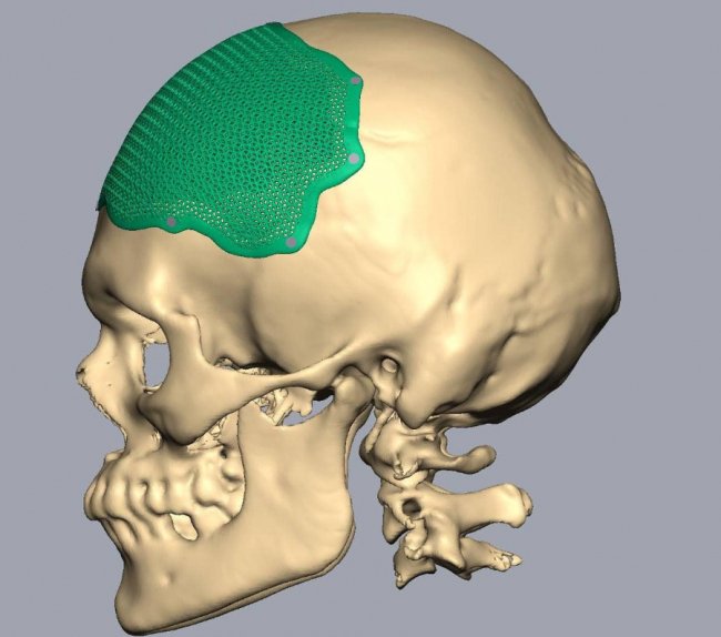 «Куля влучила в голову захисника і пройшла крізь мозок»: історія дитячого футбольного тренера з Волині 