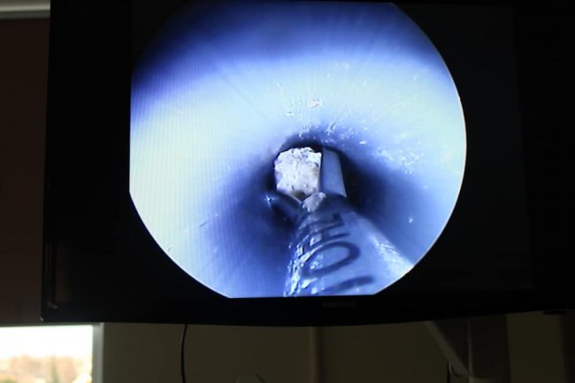 Ковельські лікарі видалили пацієнту камені з нирок через невеликий розріз