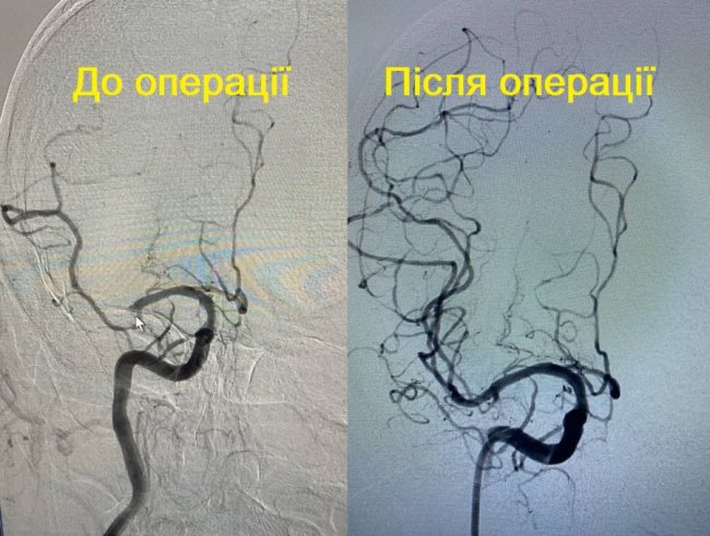 Вдалося запобігти ушкодженню мозку: у лікарні на Волині зробили дві унікальні операції 