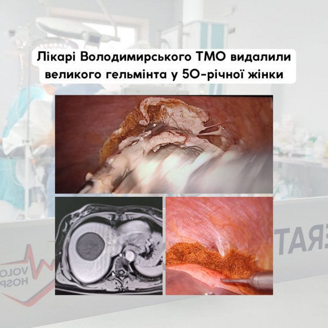 Лікарі на Волині у 50-річної жінки видалили великого гельмінта