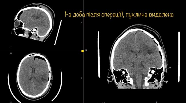 Була у свідомості: 16-річній дівчині провели складну операцію на головному мозку. ФОТО