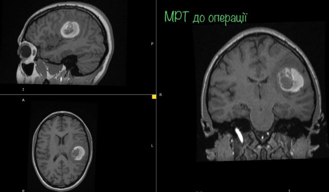 Була у свідомості: 16-річній дівчині провели складну операцію на головному мозку. ФОТО