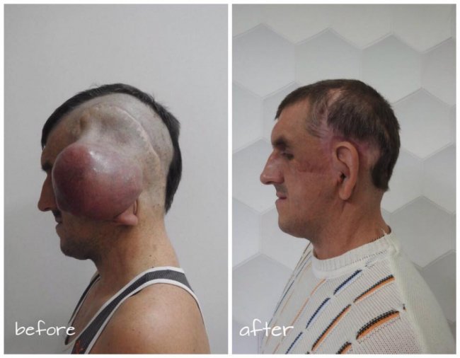 Рік потому: відомий хірург з Волині видалив з голови чоловіка велетенську пухлину