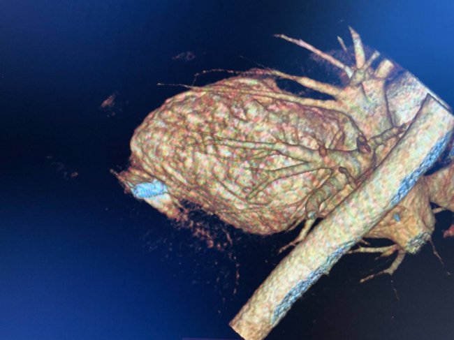 Втік із полону з кулею в серці: у «Феофанії» провели унікальну операцію 20-річному воїну