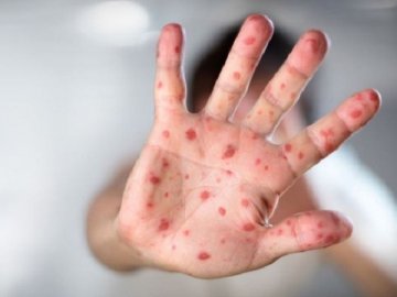 Дітей, які підхопили кір у Турійську, можуть вже невдовзі виписати із лікарні 