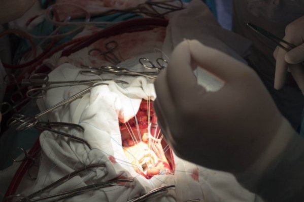 Пацієнт, якому на Волині провели унікальну операцію на відкритому серці, планує повернутися до роботи