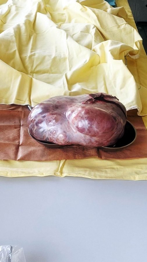 У Луцьку лікарі успішно видалили 15-річній дівчині майже 3-кілограмову пухлину. ФОТО 18+