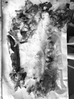 Волинські хірурги видалили жінці пухлину із «сюрпризом». ФОТО 18+